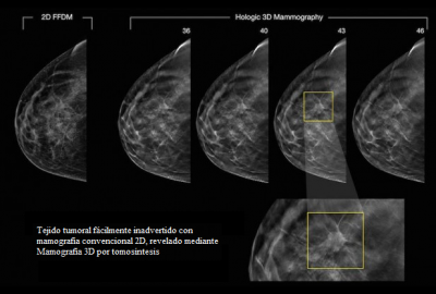 mamografía tecnología